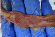 An Effective Strategy to Control Necrotic Enteritis in Monsoon Season